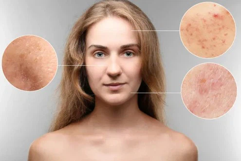 Squaric Acid Treatment order | Shaanxi BLOOM Tech Co., Ltd Squaric Acid Treatment order | Shaanxi BLOOM Tech Co., Ltd