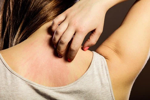 Squaric Acid Treatment where to buy | Shaanxi BLOOM Tech Co., Ltd Squaric Acid Treatment where to buy | Shaanxi BLOOM Tech Co., Ltd